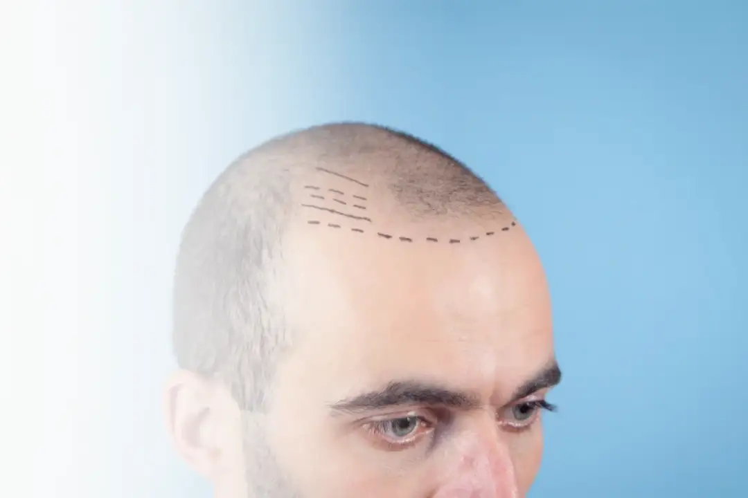 FUE hair transplant procedure at Istanbul Care