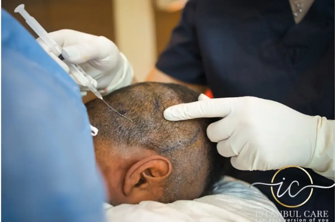  hair transplant in turkey