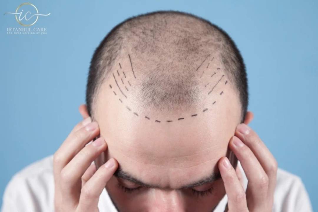 Mit chirurgischem Stift auf der Kopfhaut eines Patienten angezeichneter Haaransatz vor einer Haartransplantation.
