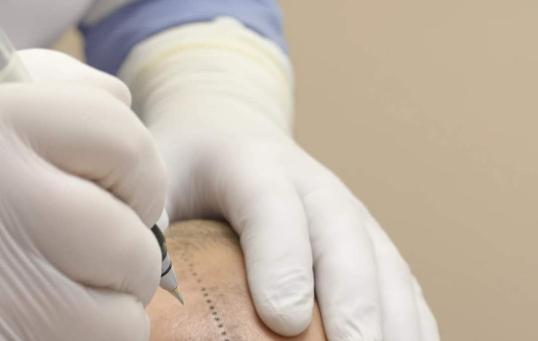 Línea de implantación marcada en el cuero cabelludo antes de un procedimiento de trasplante capilar