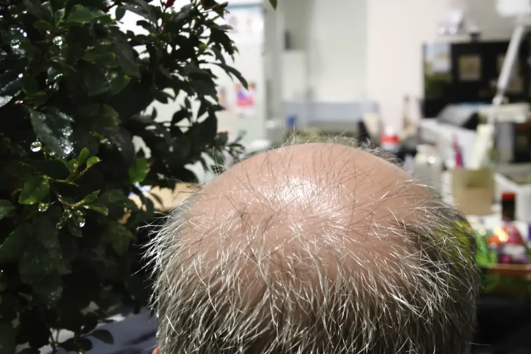 How Much Does a Hair Transplant in Turkey Cost in 2026? A Transparent Breakdown