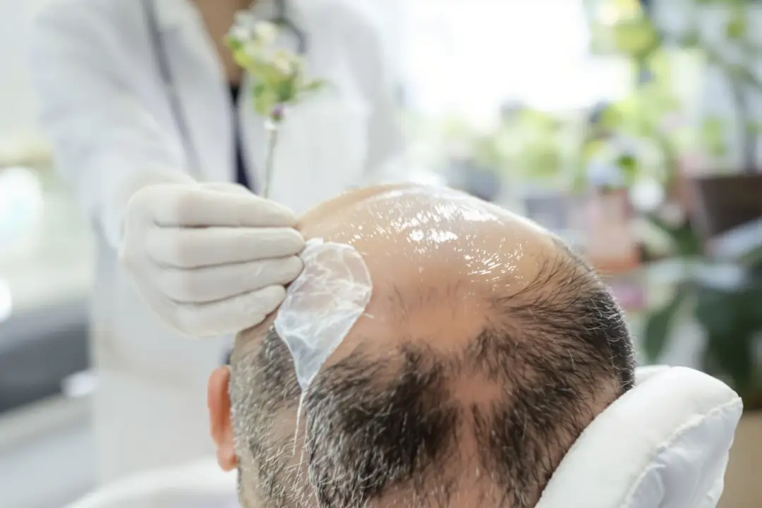 Hair Transplant Pain: What to Really Expect