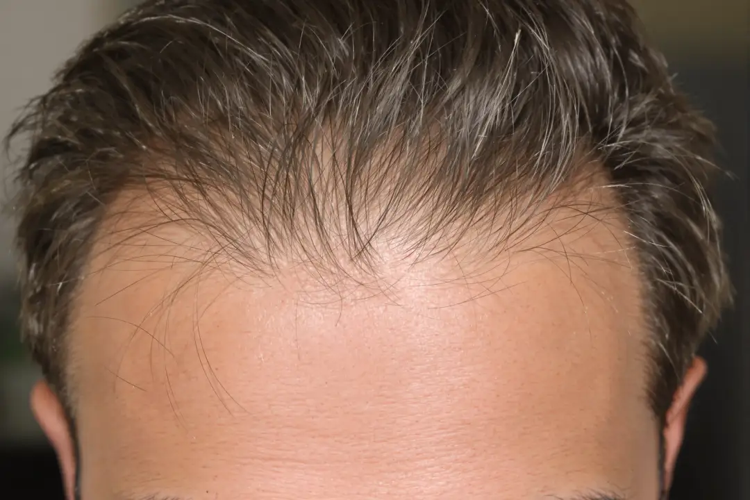 Hair Transplant Results Timeline: Month by Month