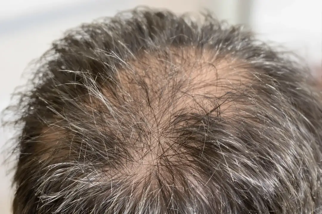 Hair Transplant Scars: FUE vs FUT Explained