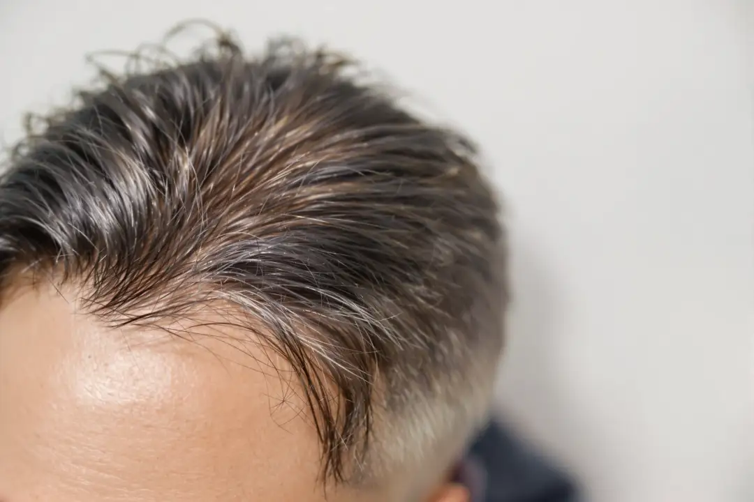 Is a Hair Transplant Permanent? The Facts