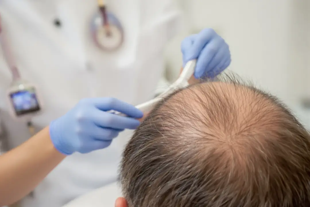Hair Transplant Cost UK: Why Insurance Won't Pay