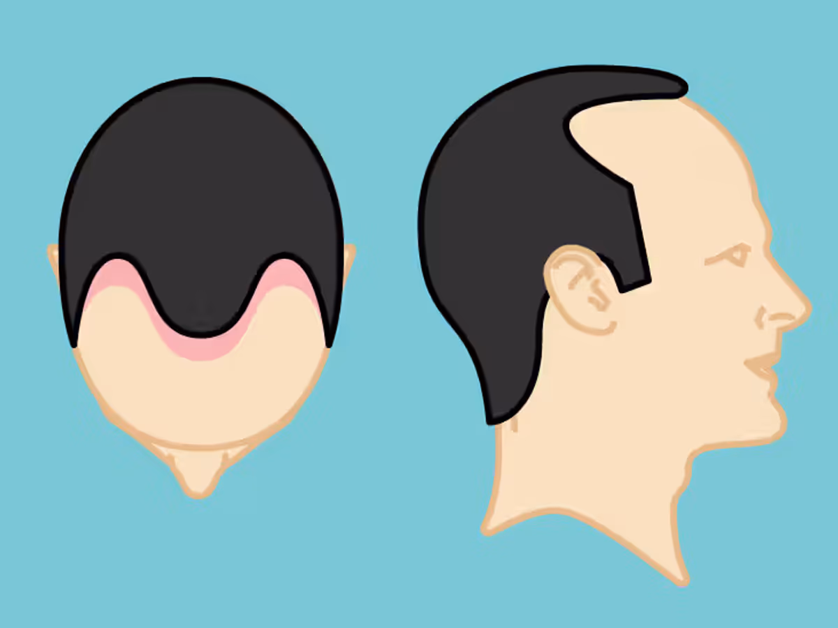 Norwood Scale- Degrees of Baldness — What It Means.avif