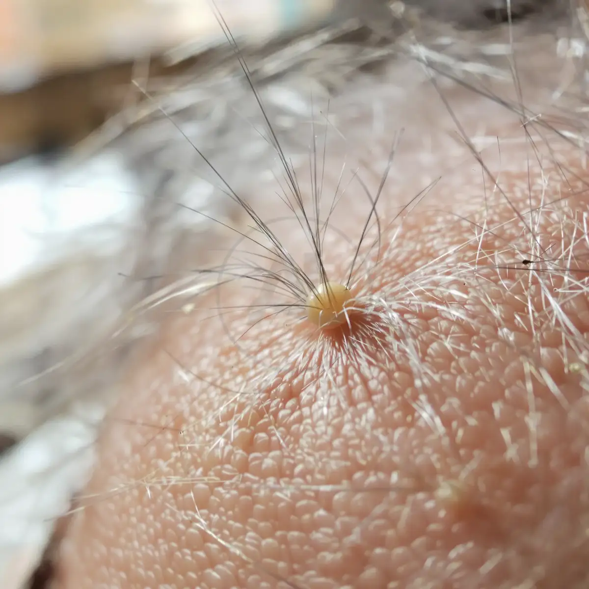 Macro shot of a follicular unit emerging from the scalp