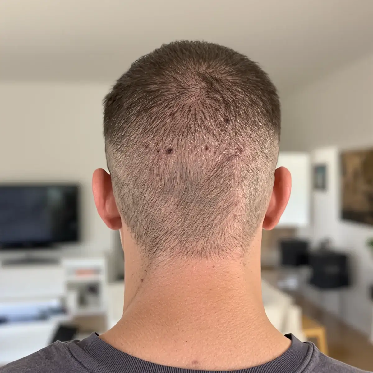 Nuca di un paziente con la zona donatrice in ricrescita dopo il trapianto, ciò che le foto prima e dopo rivelano davvero – Albania Hair Clinic
