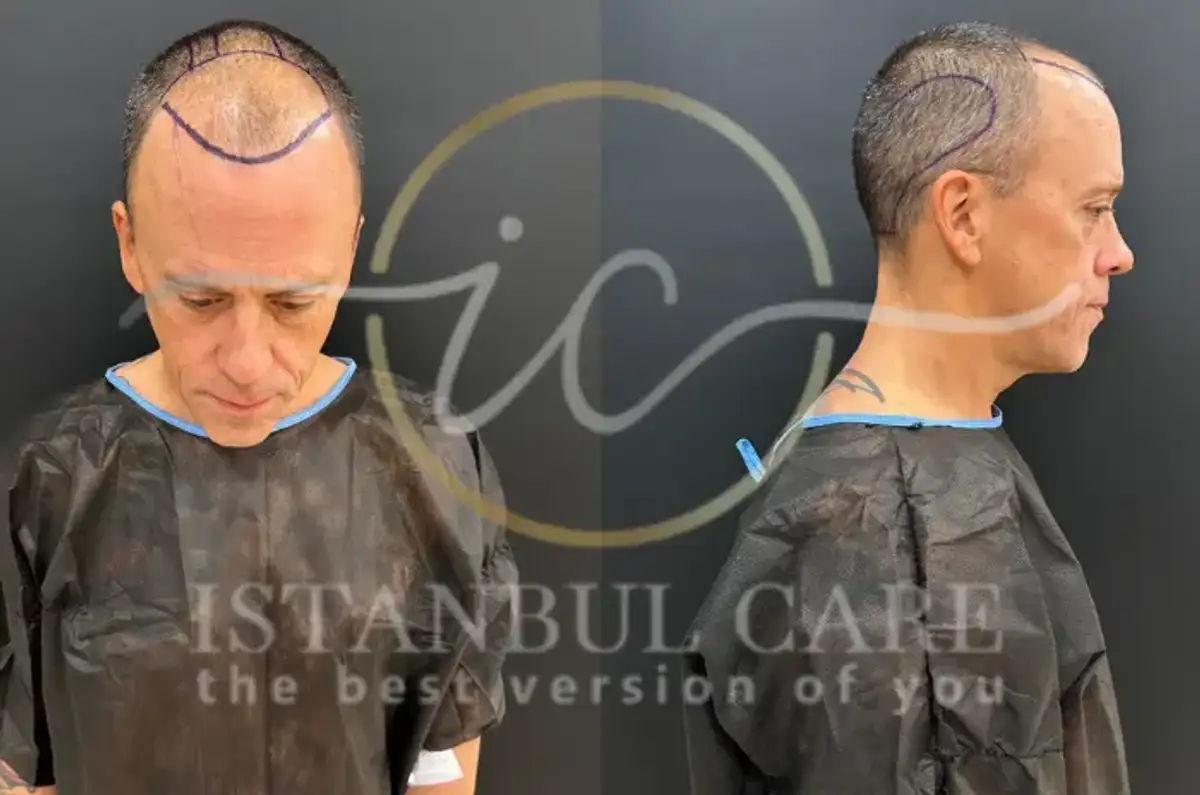 Benefici e risultati della procedura di trapianto di capelli