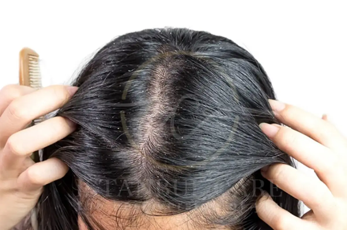 Lice-vs-dandruff.webp