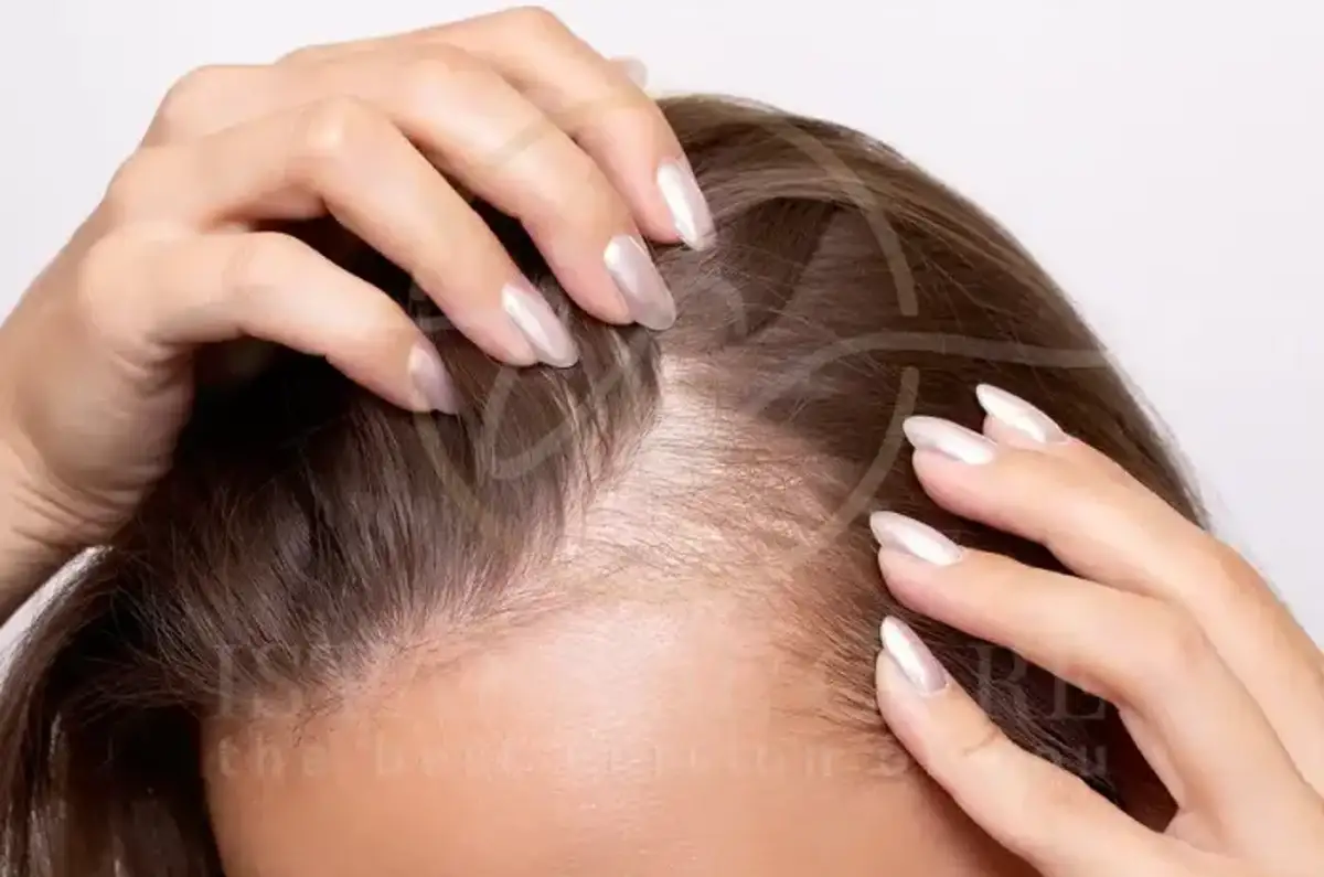 Quelle hormone provoque la chute des cheveux chez les femmes (1)
