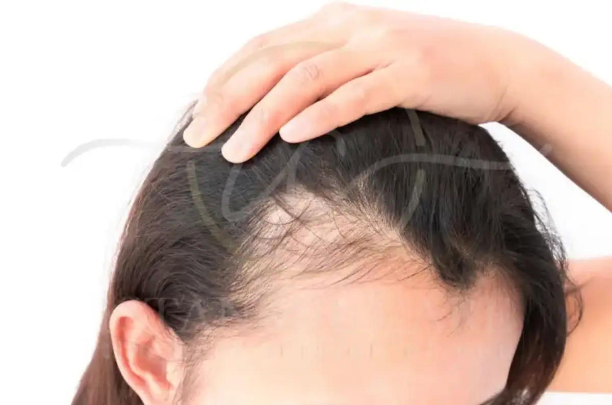 Quelle est l'hormone responsable de la chute des cheveux chez les femmes ?