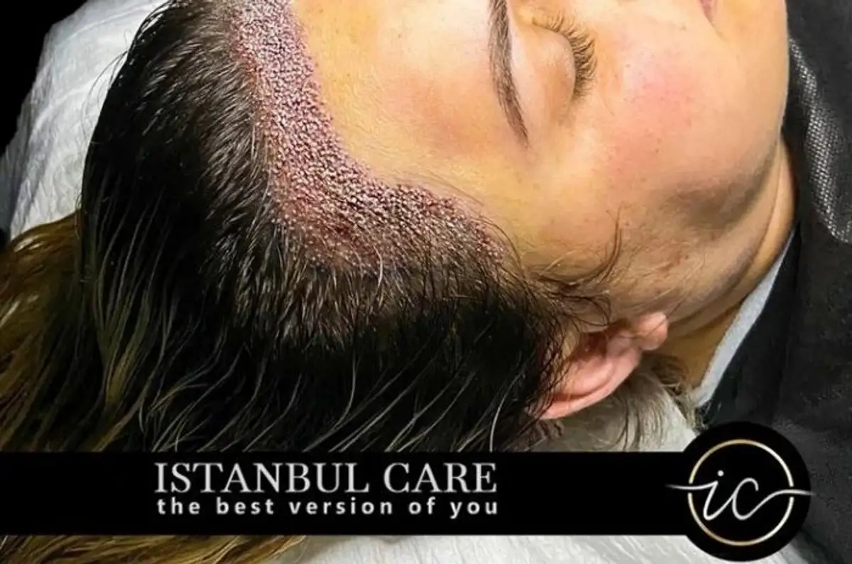 Woman recovering after hair transplant procedure with medical staff guidance