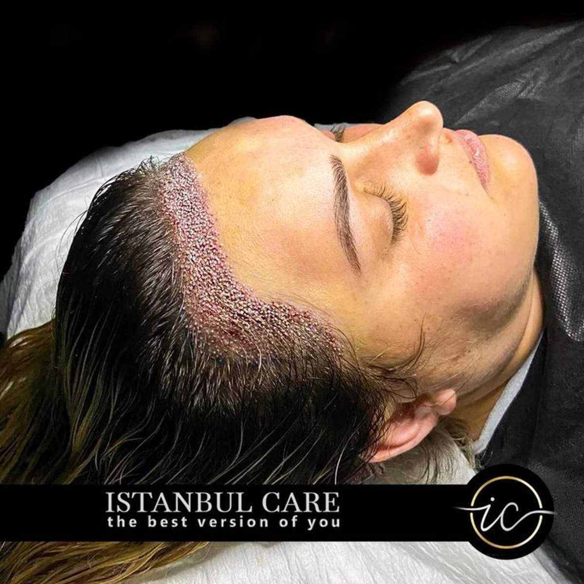 Transplantation de cheveux chez la femme