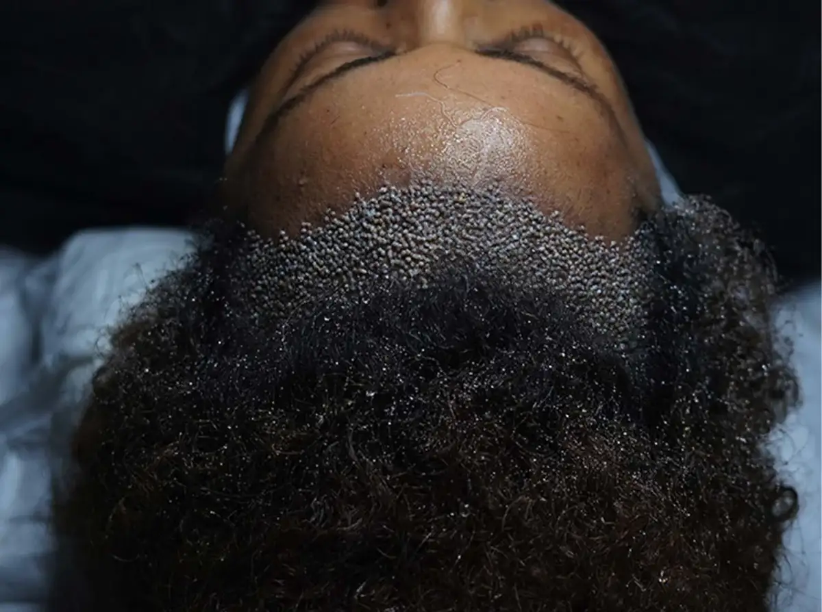 Primo piano di una donna nera sdraiata con innesti appena posizionati che formano una nuova attaccatura frontale tra i suoi capelli ricci