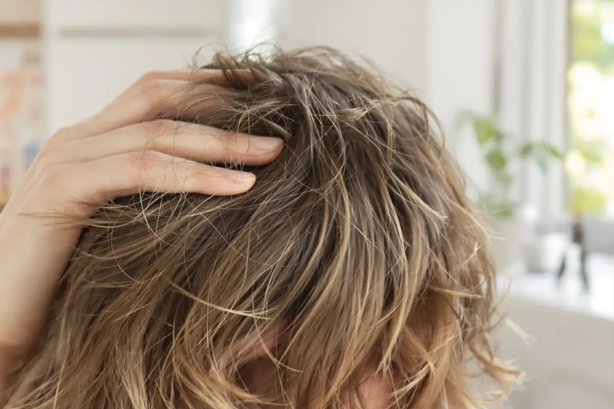 Understanding How Vitamin Deficiency Causes Hair Loss