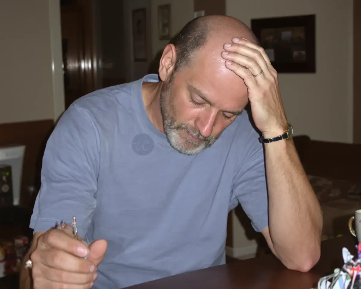 Man with advanced balding across the crown and front resting his hand on his bare scalp