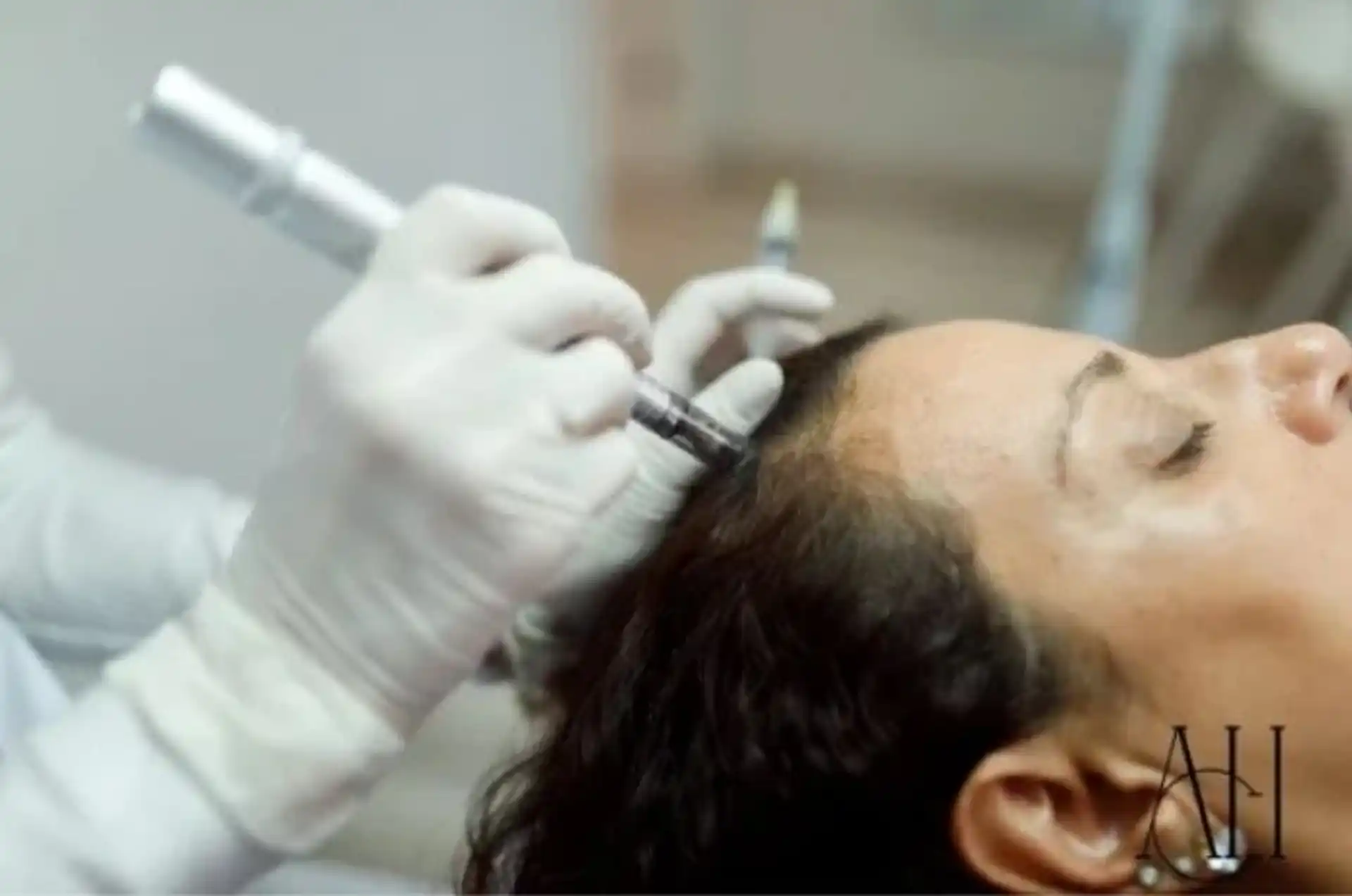 Trapianto di capelli per donne in Albania