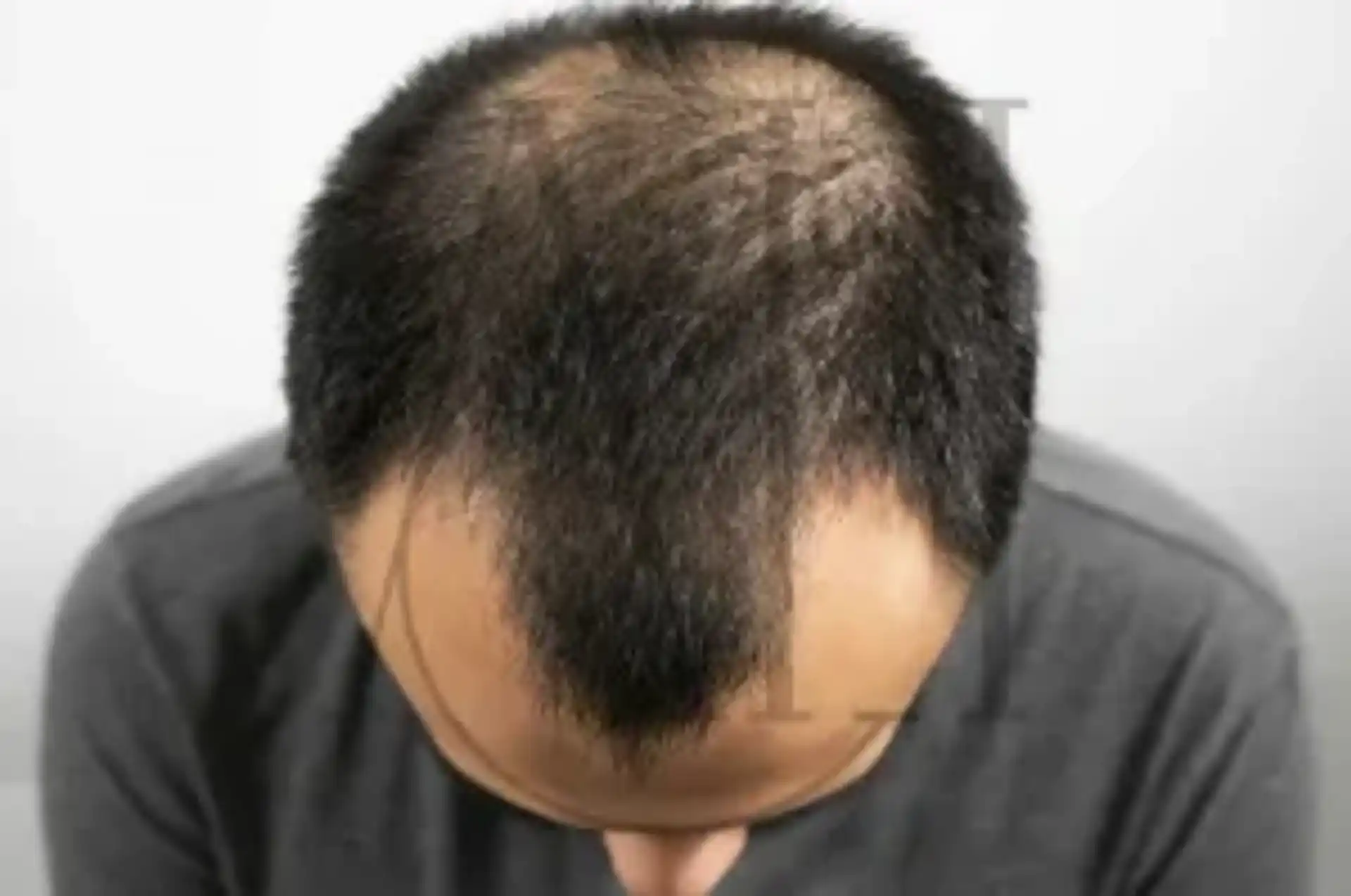 Ultimi sviluppi nel trattamento di nuova generazione per la perdita di capelli