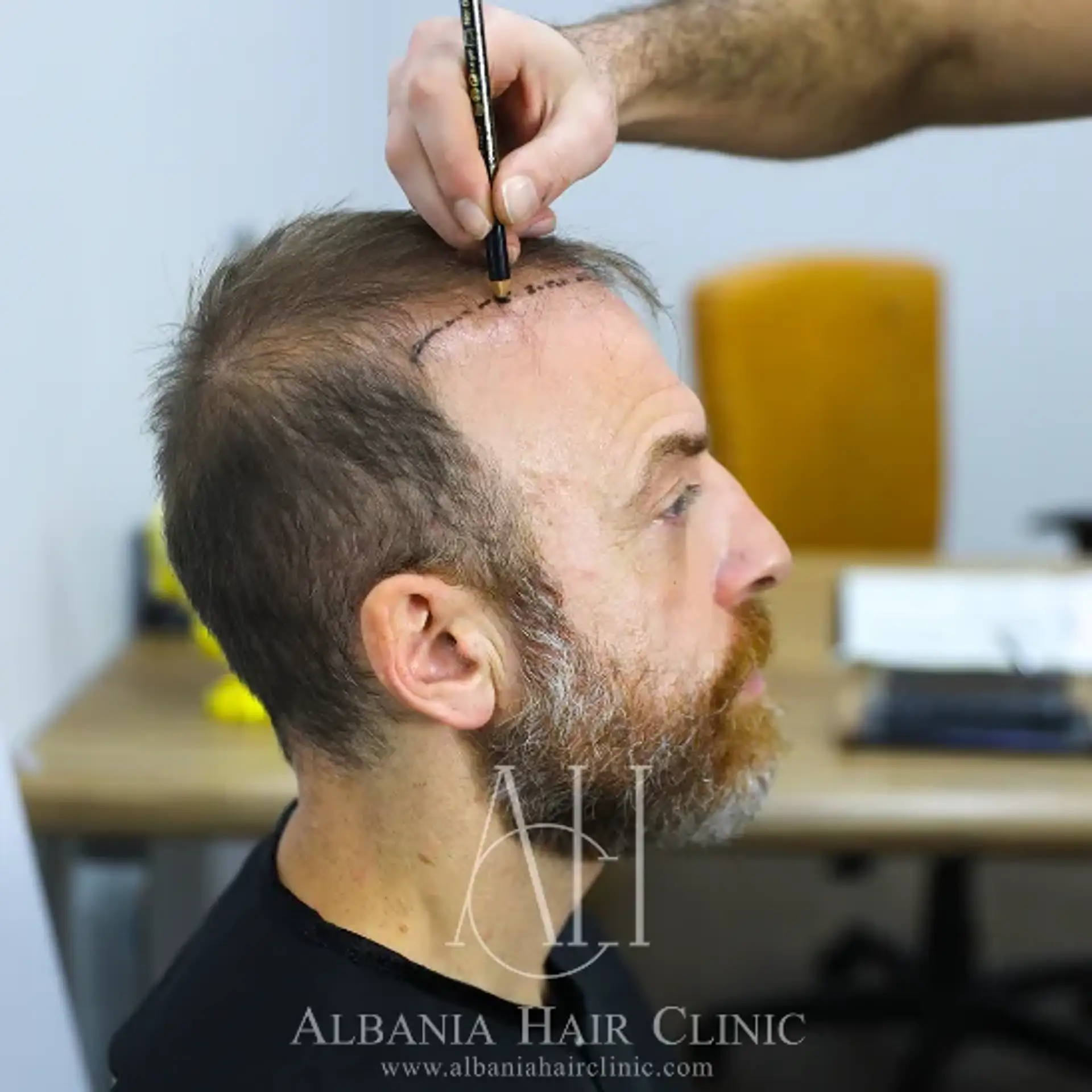 Trapianto DHI in Albania
