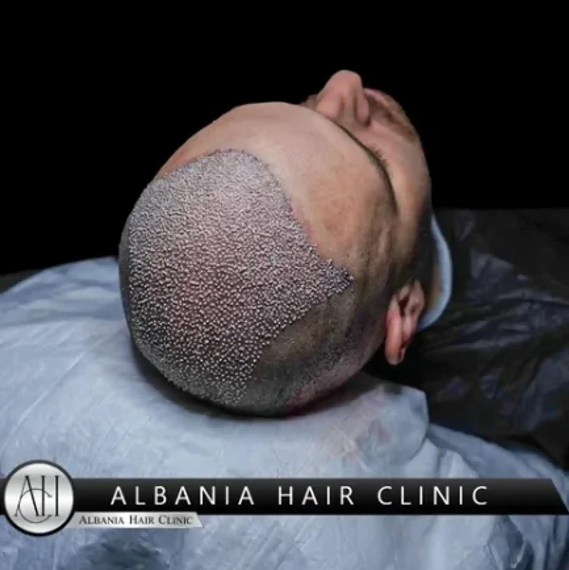 FUE Hair Transplant in Turkey