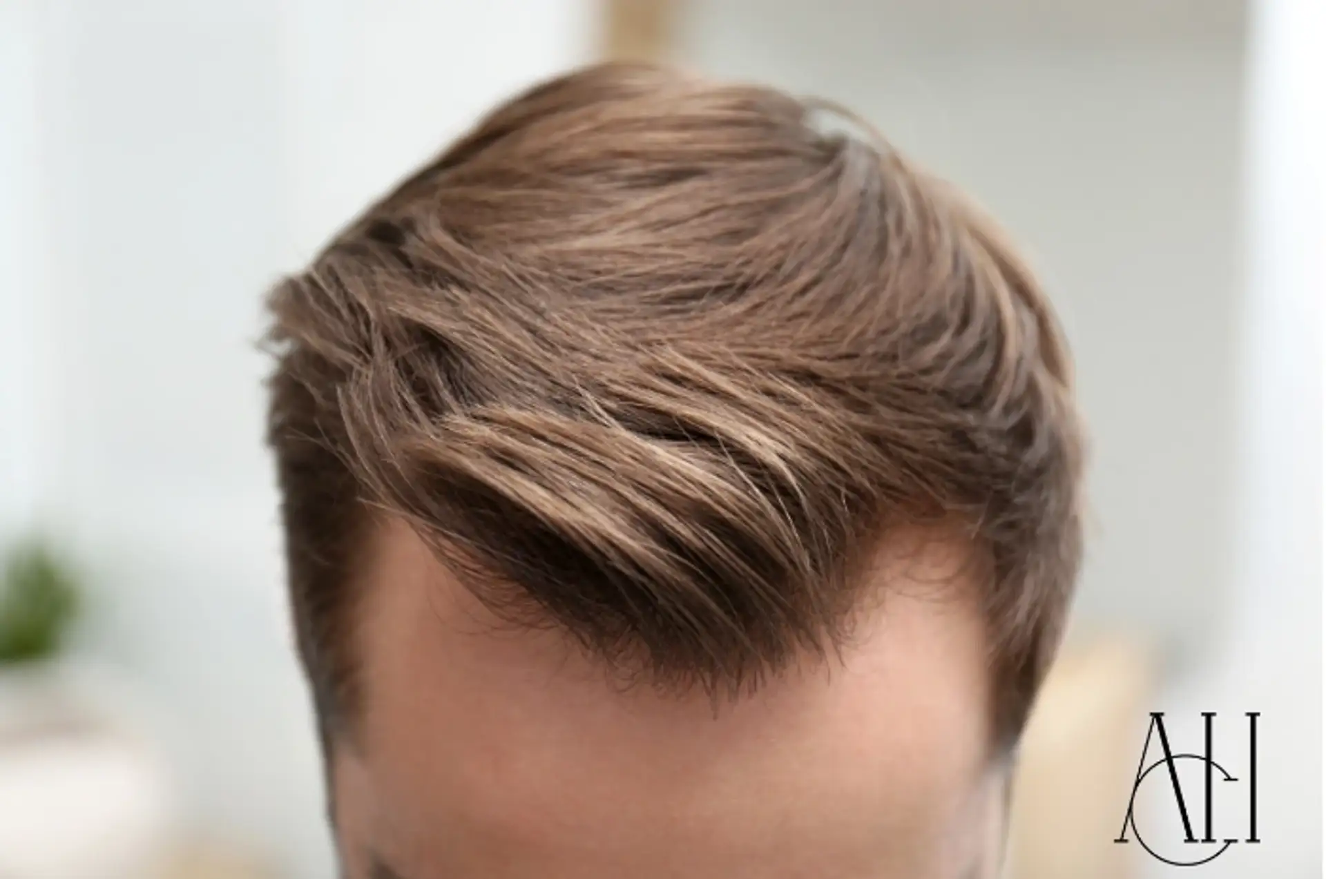 Learn essential hair transplant aftercare tips to ensure optimal healing and long-lasting results. Follow these expert guidelines!