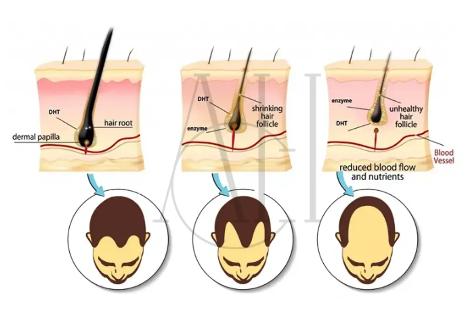 DHT and hair loss