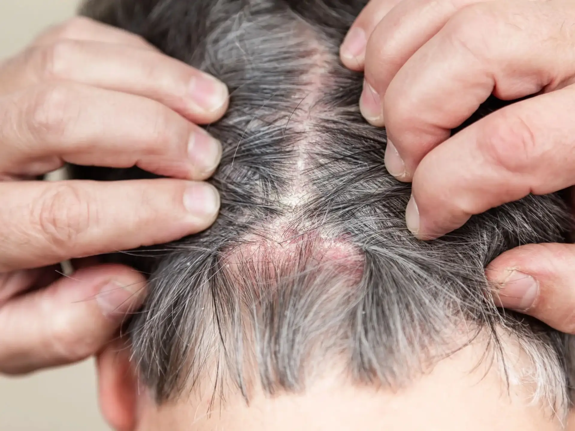itchy-scalp-and-hair-loss