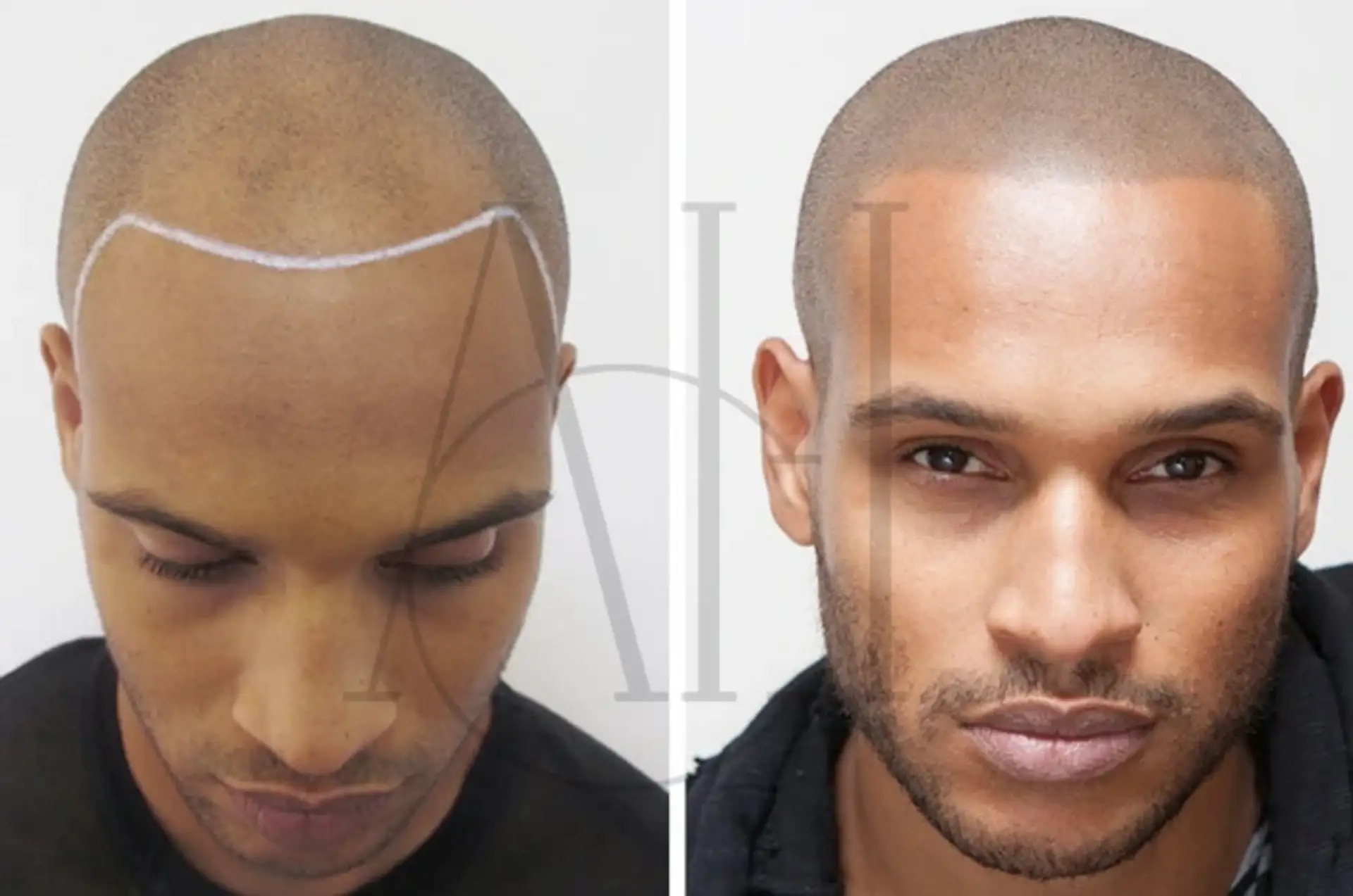 head tattoo hair