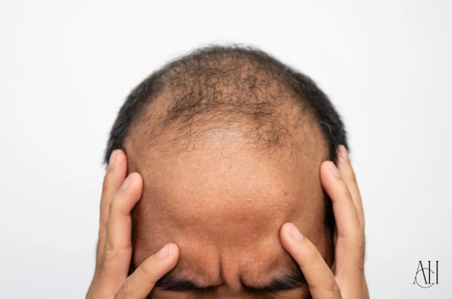 stress hair loss symptoms