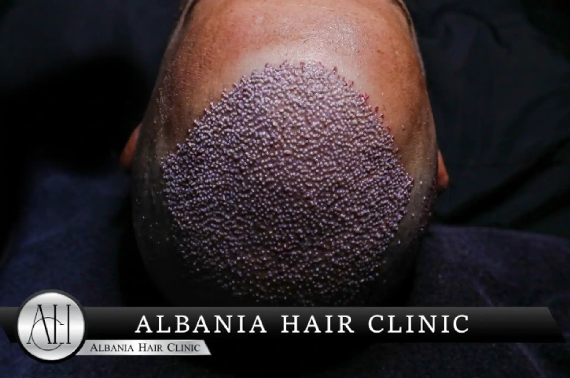 do hair transplants last​
