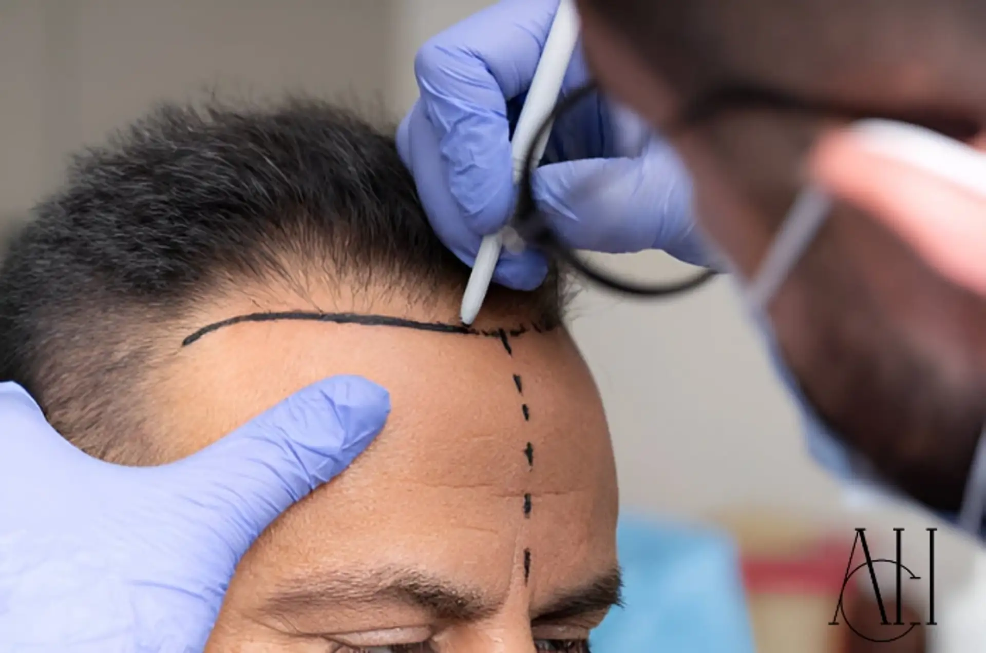 Dopo il trapianto di capelli