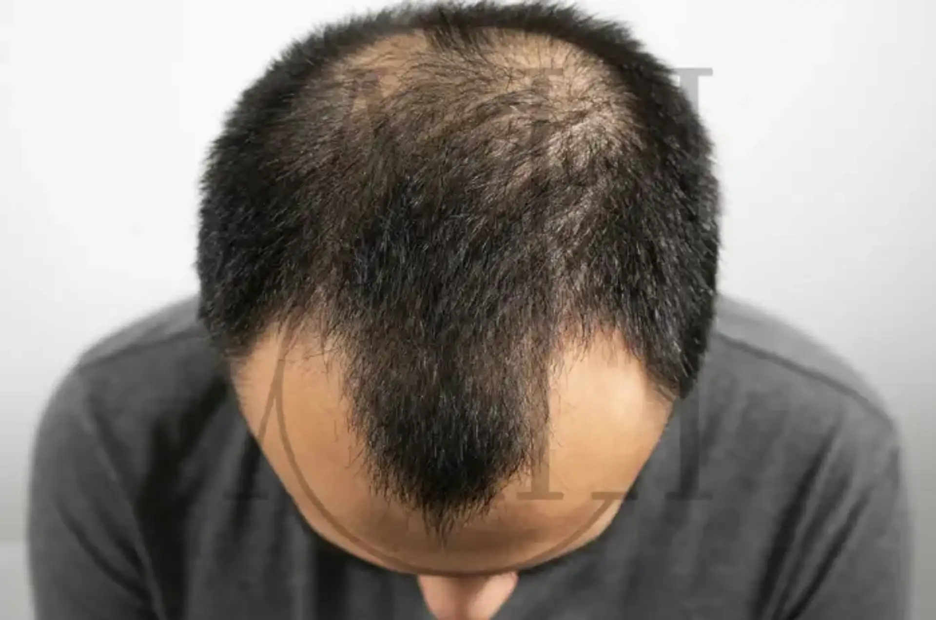 Ultimi sviluppi nel trattamento di nuova generazione per la perdita di capelli