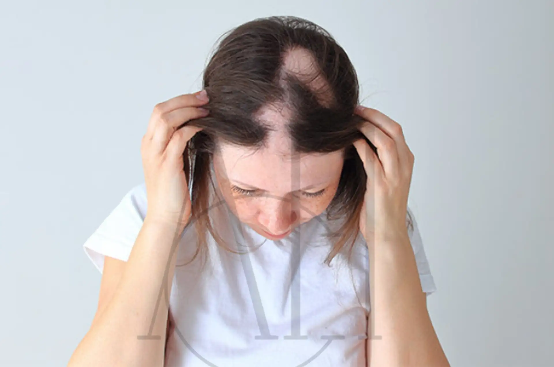 LPP hair loss