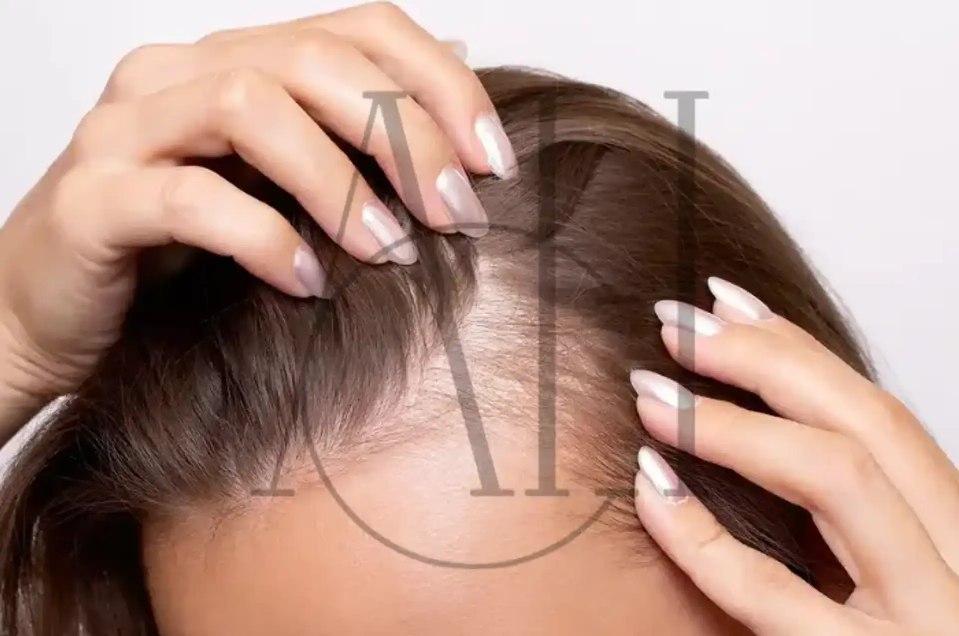 Hair Loss in Women