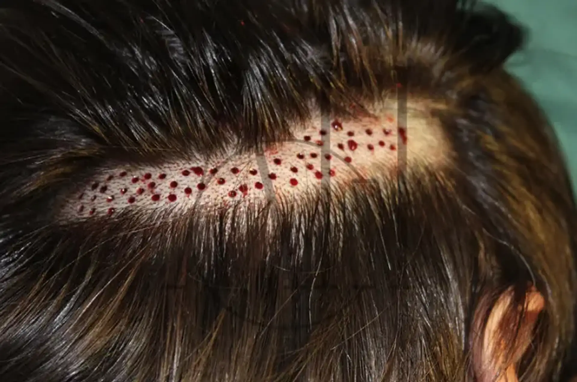 Scalp Biopsy Procedure Steps