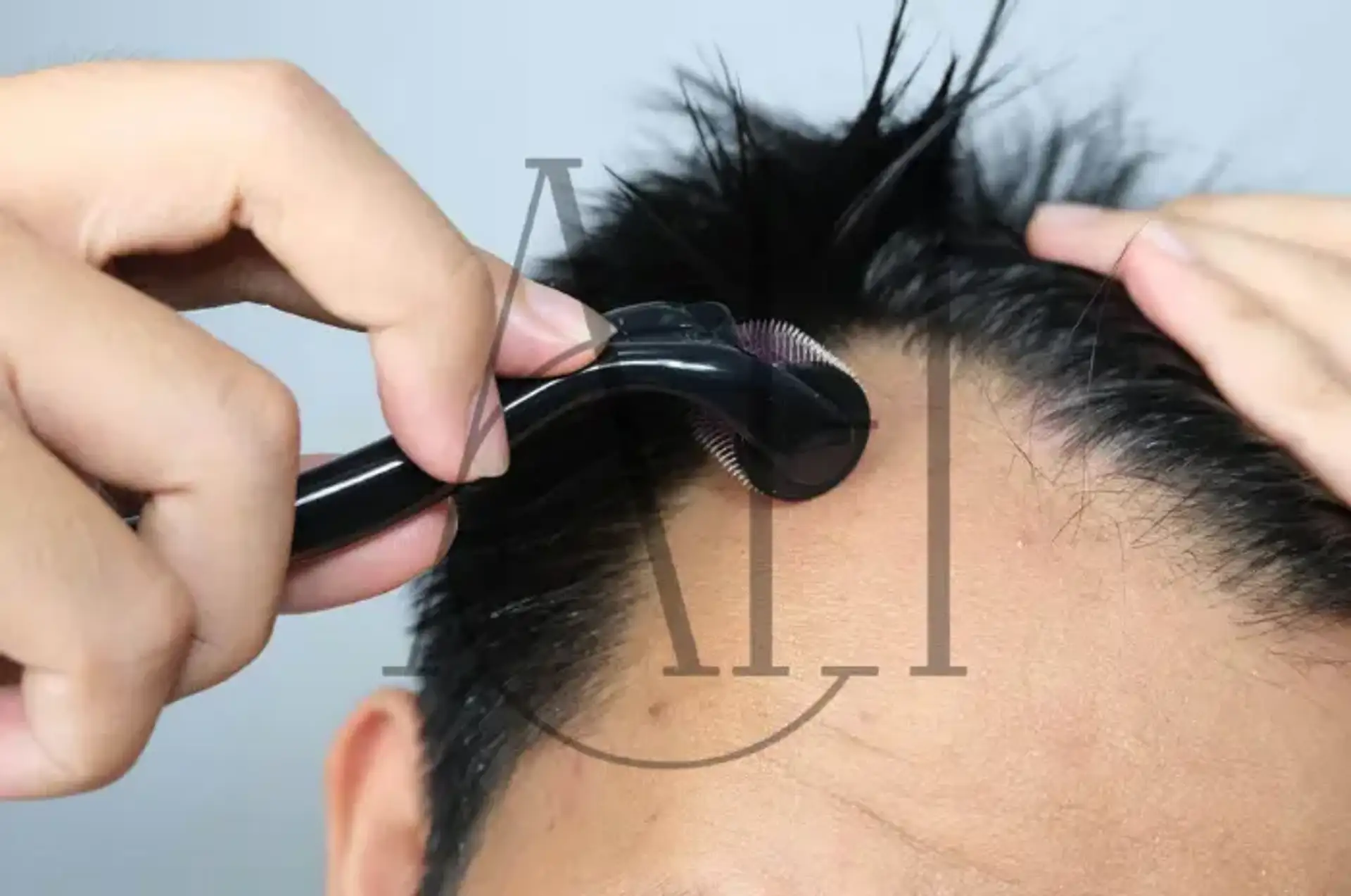 Derma Roller For Hair Growth Expert Review