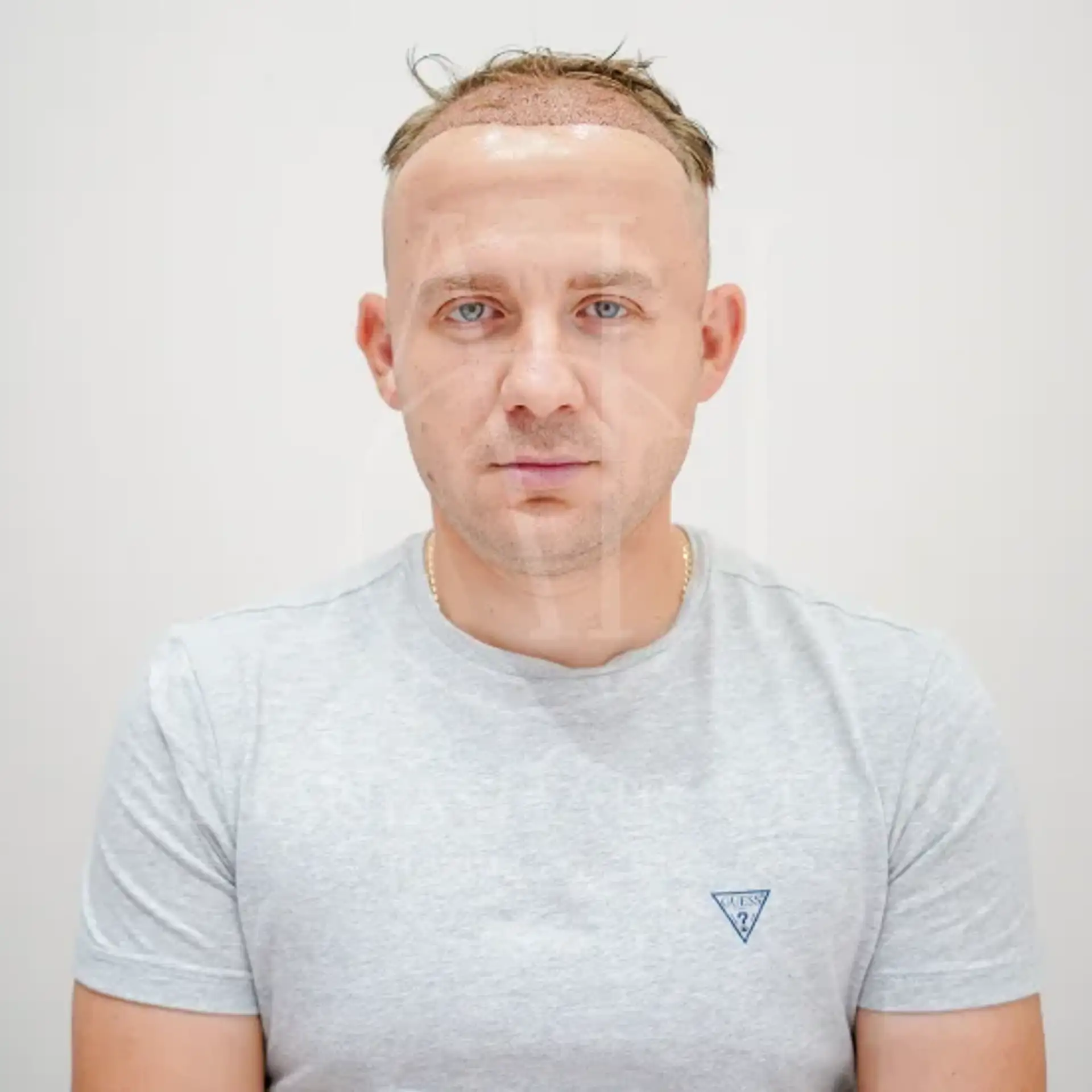 Needle Free Hair Transplant – The Future of Hair Restoration