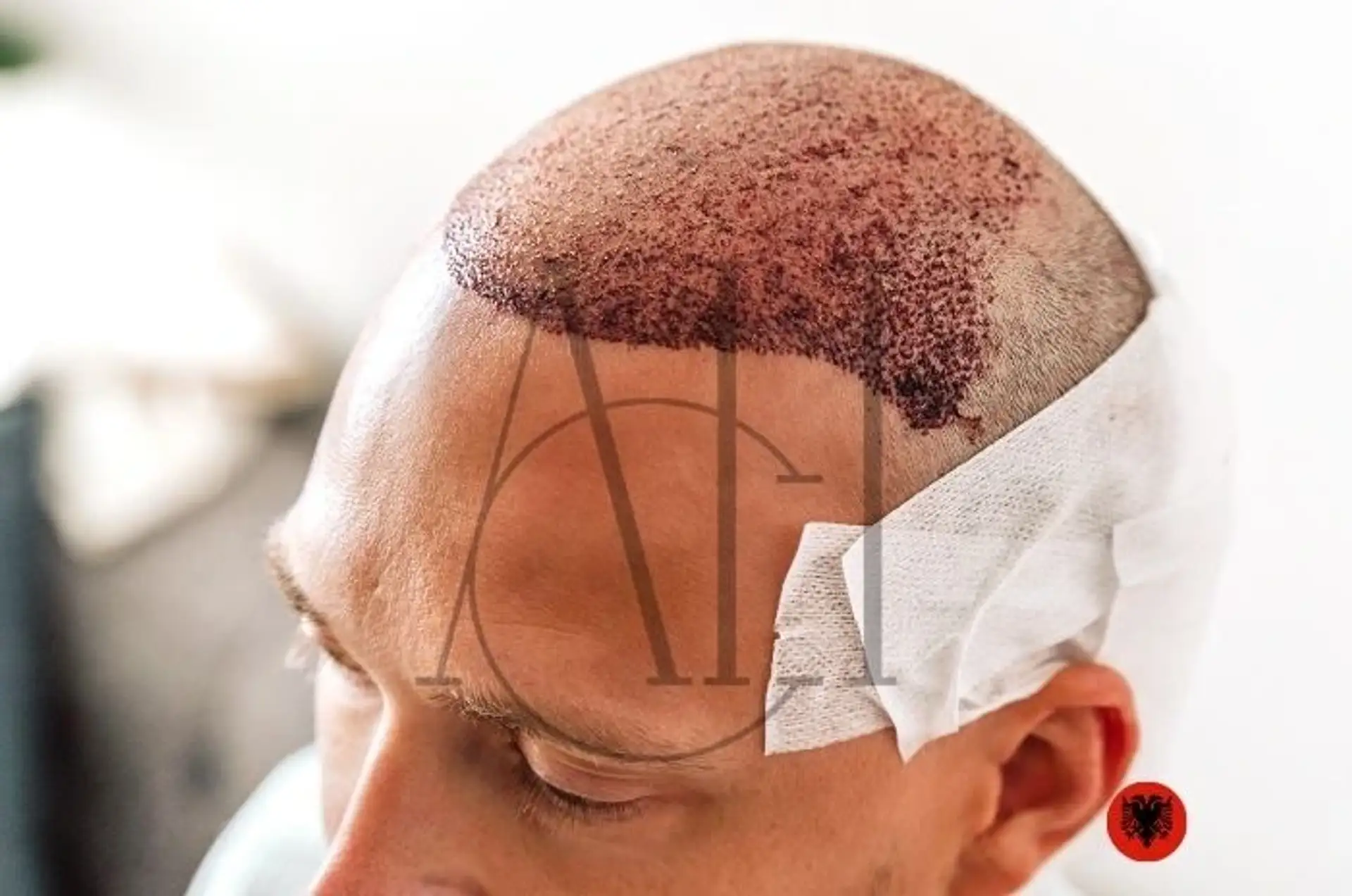 Hair Transplant Packages in Albania