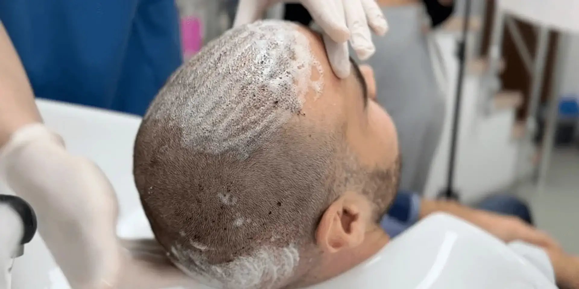 Recovery period after hair transplant