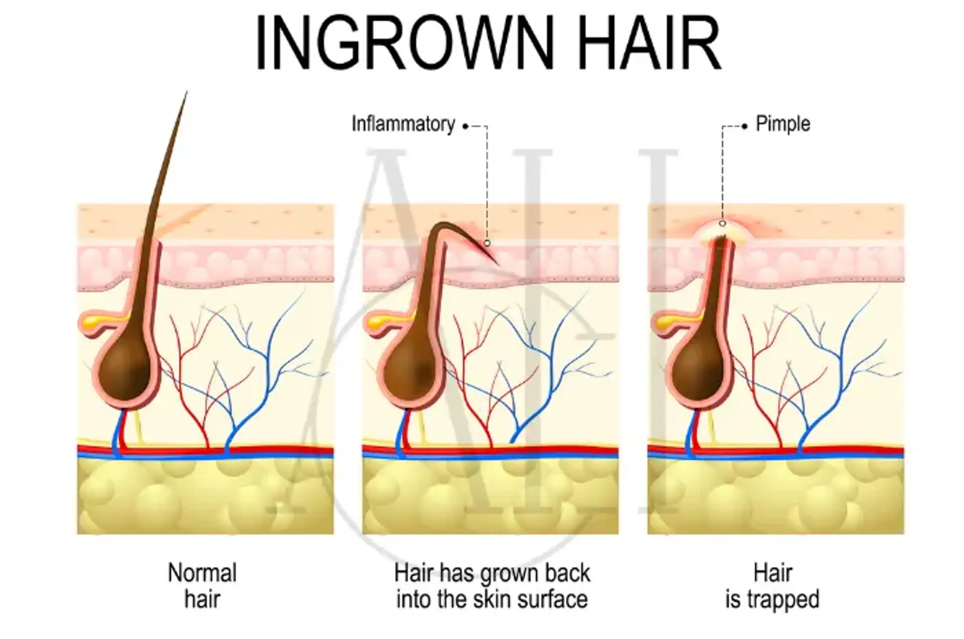 ingrown hair
