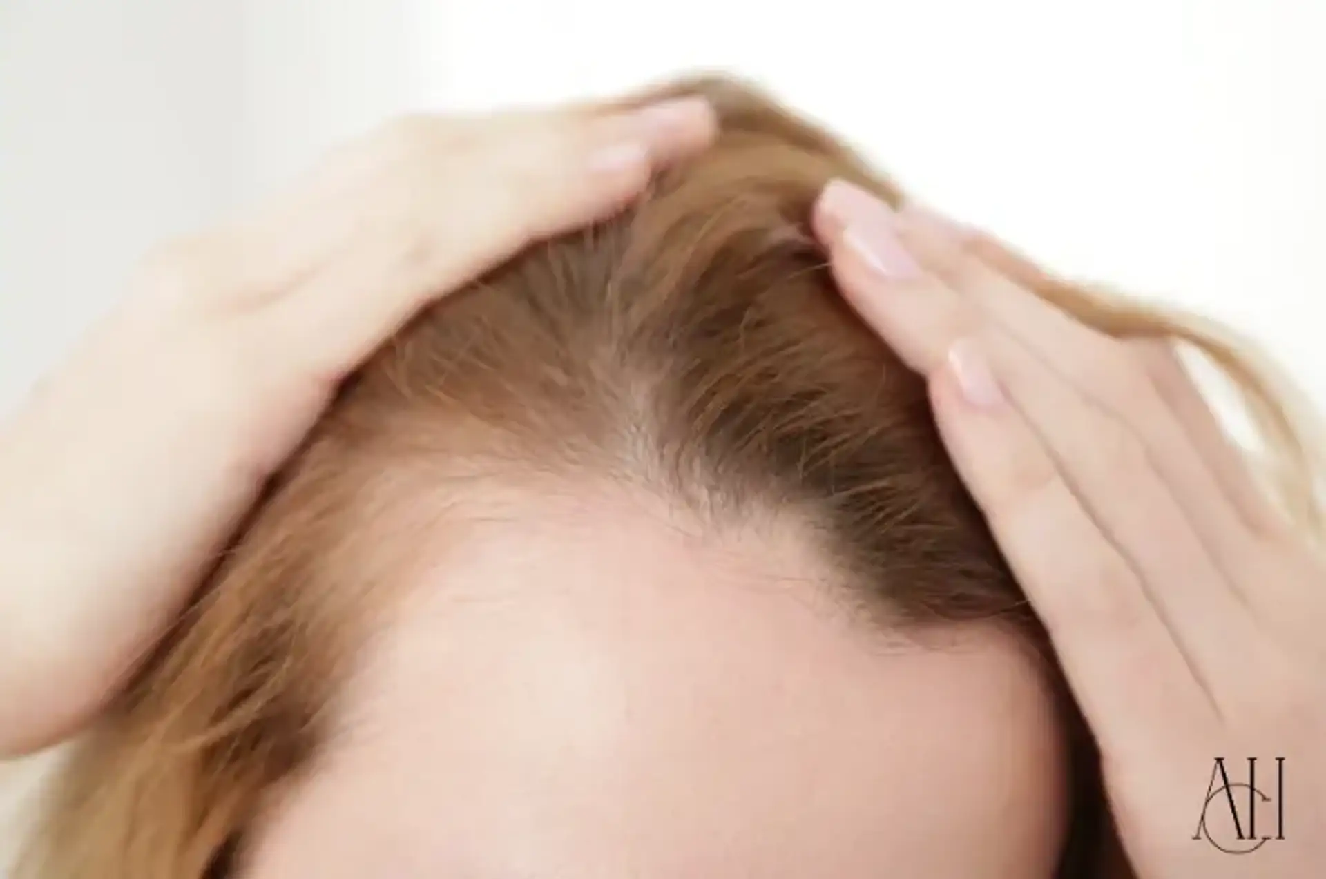 women hairline recession