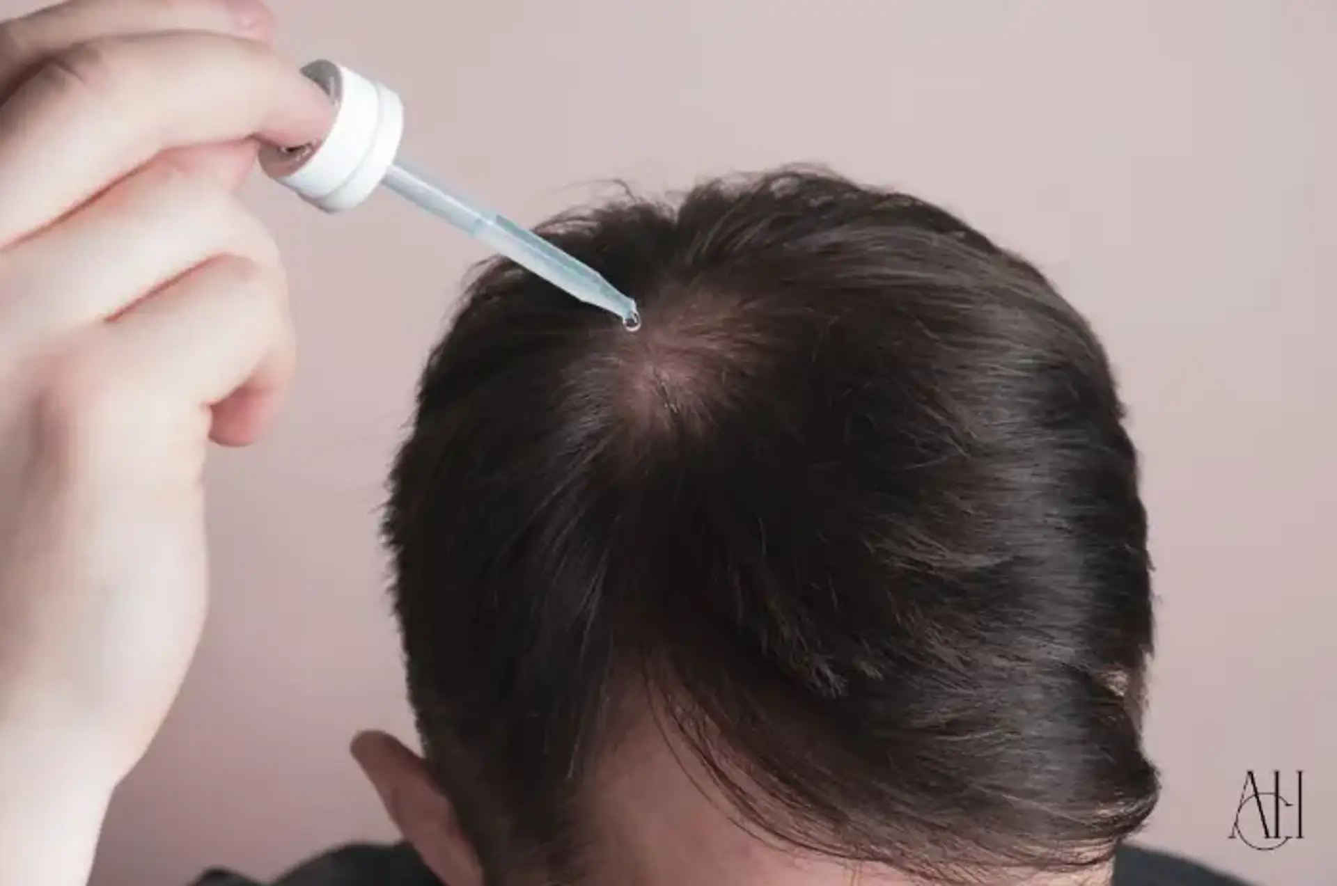 Sintomi della perdita di capelli da stress