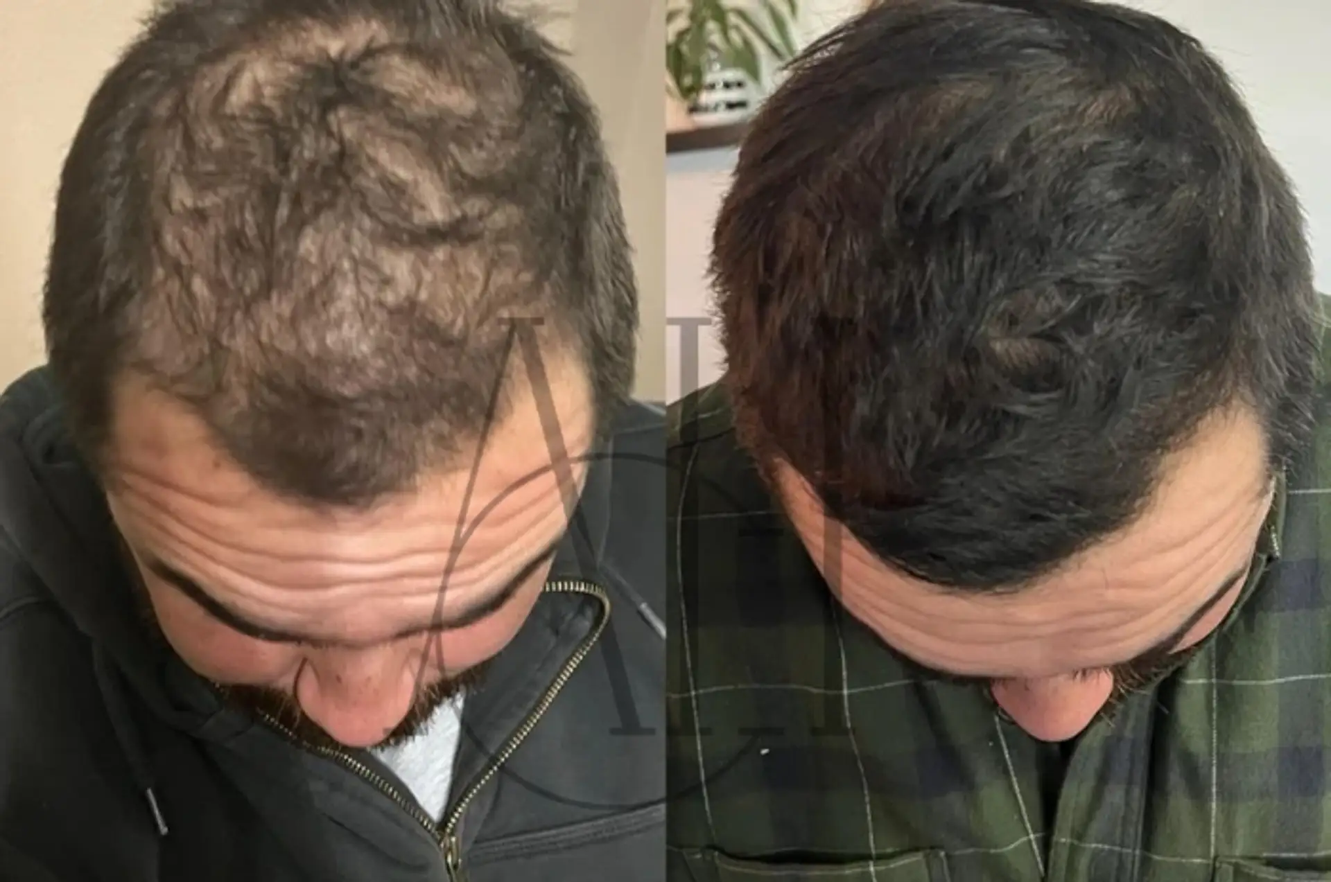 Minoxidil for Hair Loss