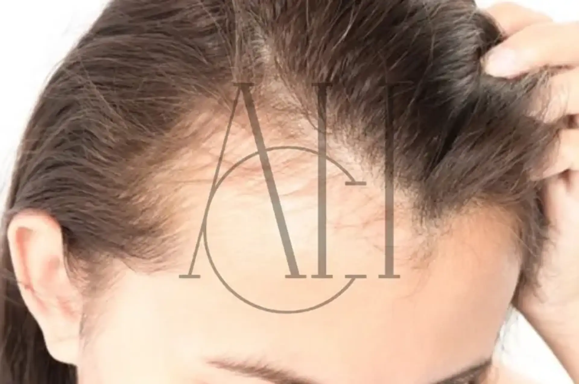 I capelli ricrescono dopo l’alopecia da trazione