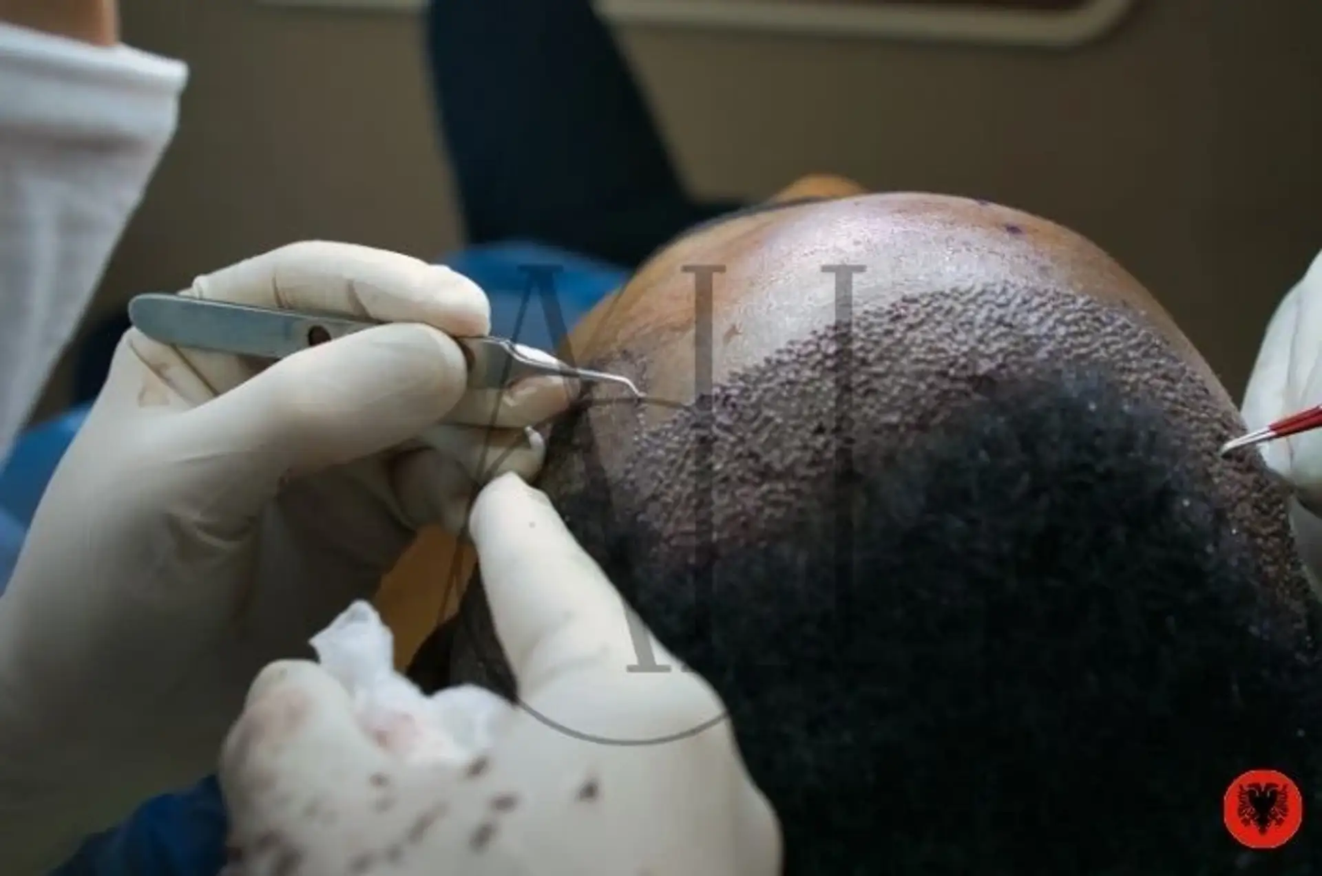 Trapianto Capelli Albania: Costi e Tecniche a Confronto