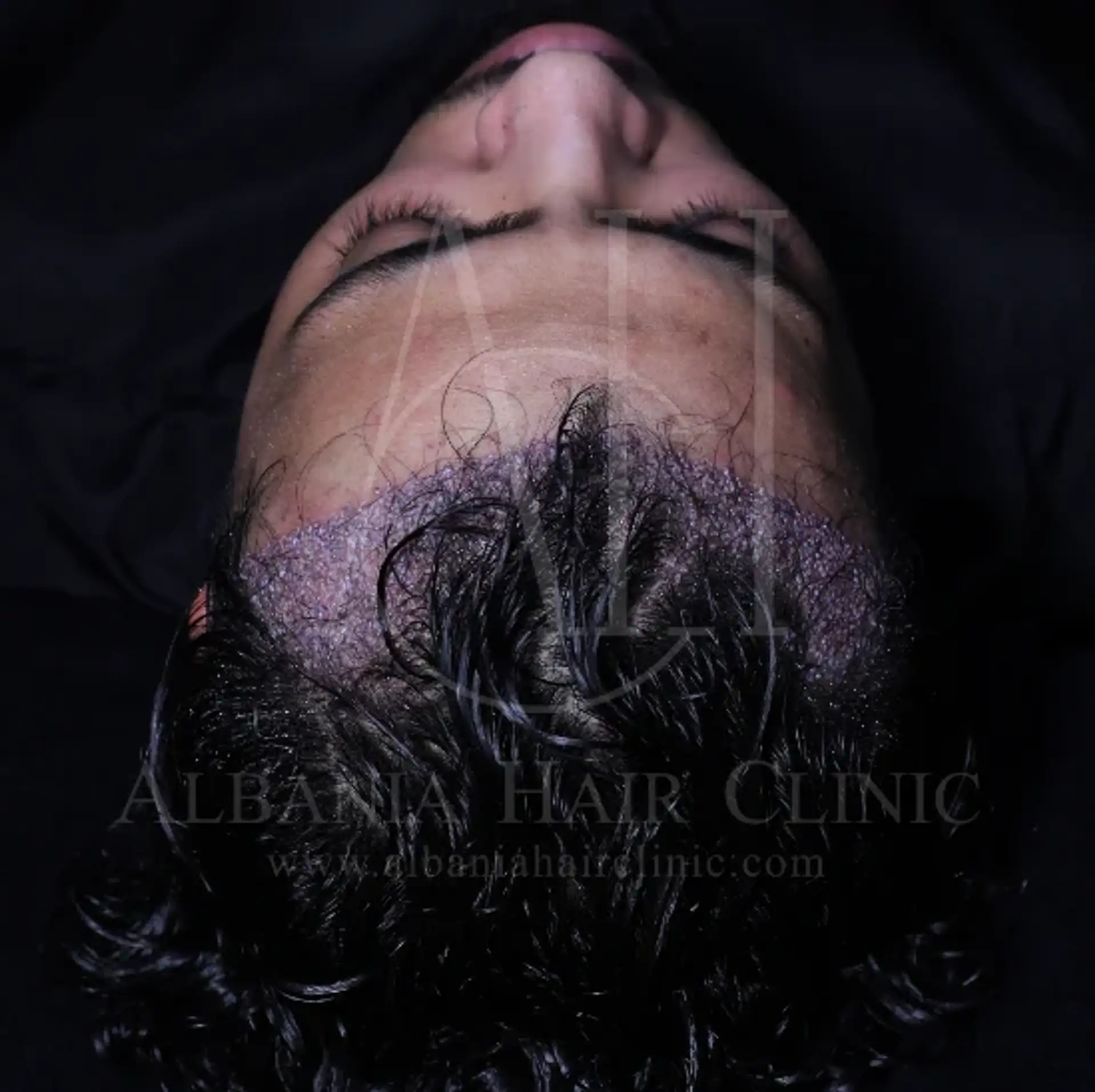 Hair Transplant Anesthesia Options: What You Need to Know