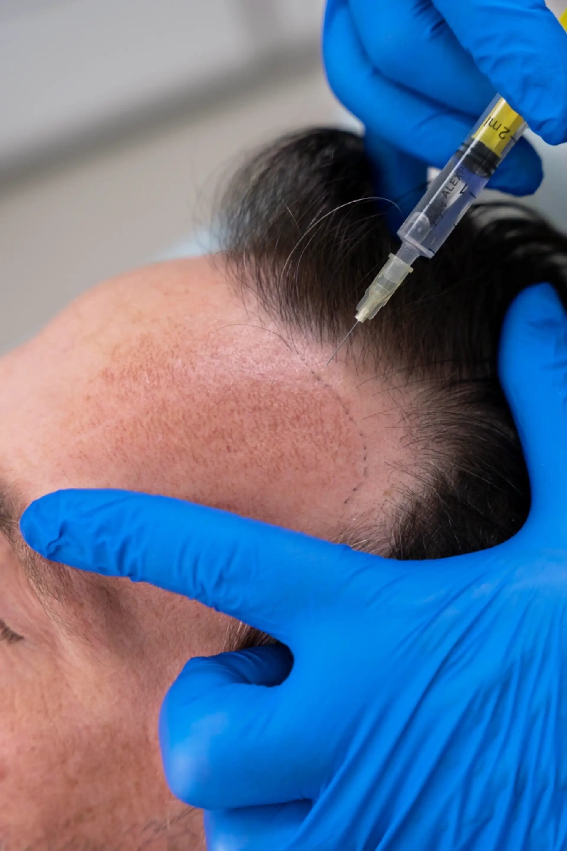 La tecnica del trapianto di capelli con zaffiro è dolorosa?