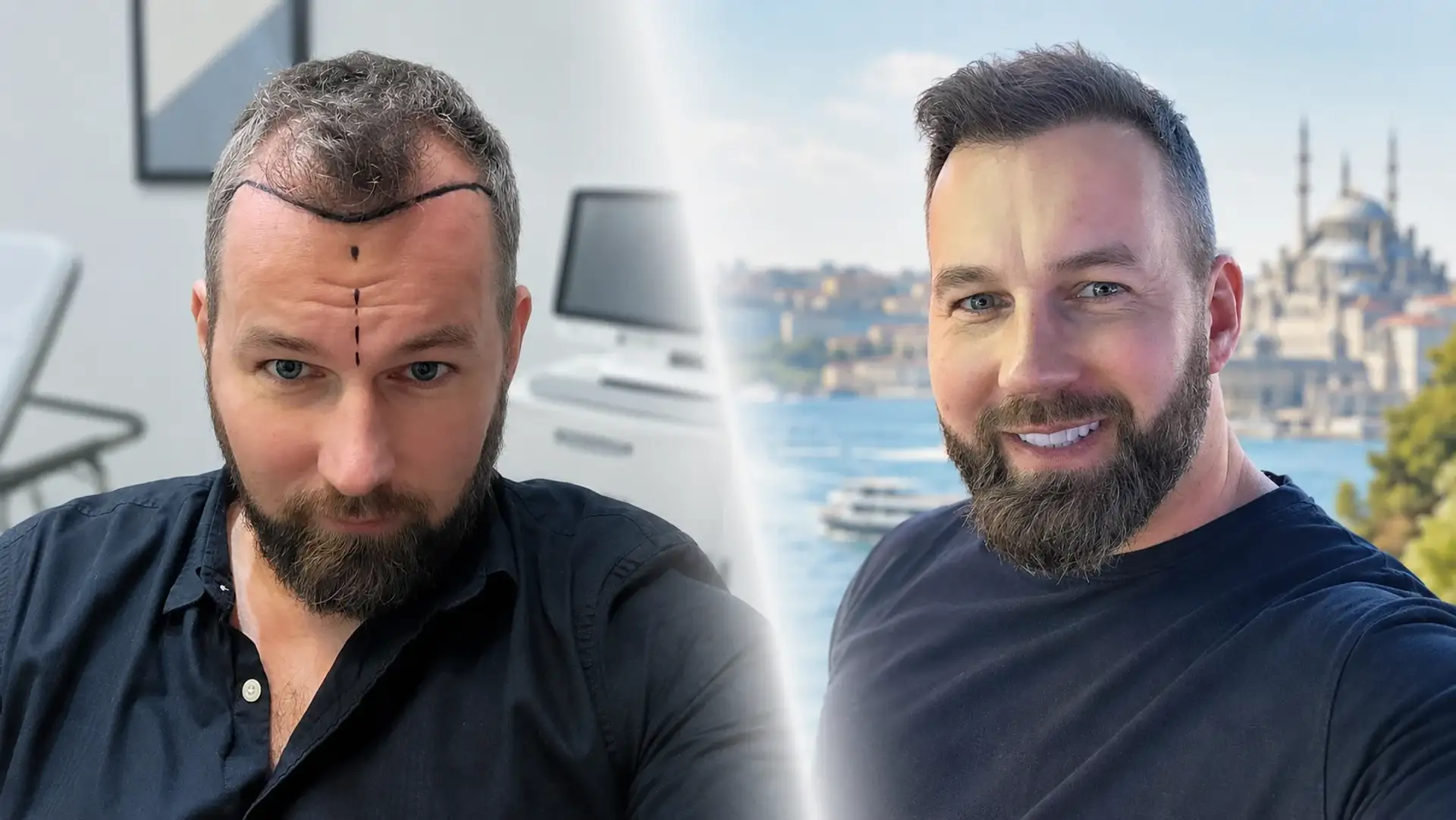 Prima e dopo del trapianto di capelli in Turchia